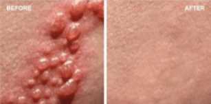 Beyond Simplex-Benefits